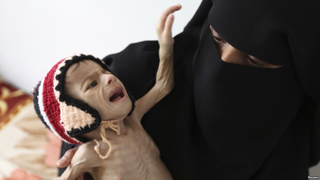 Yemen hunger4