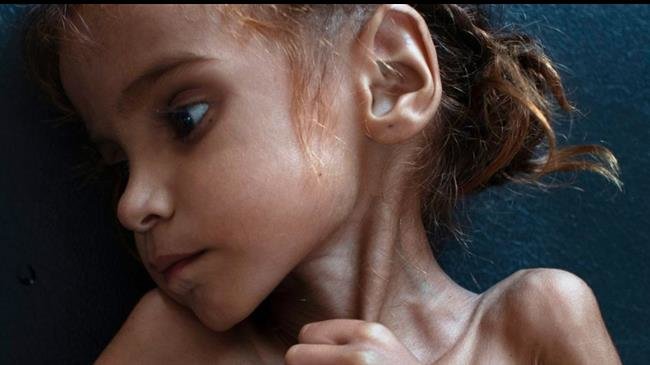 Дети Йемена умирают от истощения