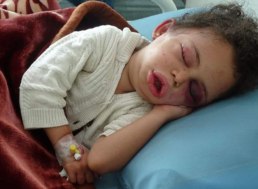 ООН: «Ситуация в Йемене будет только ухудшаться»