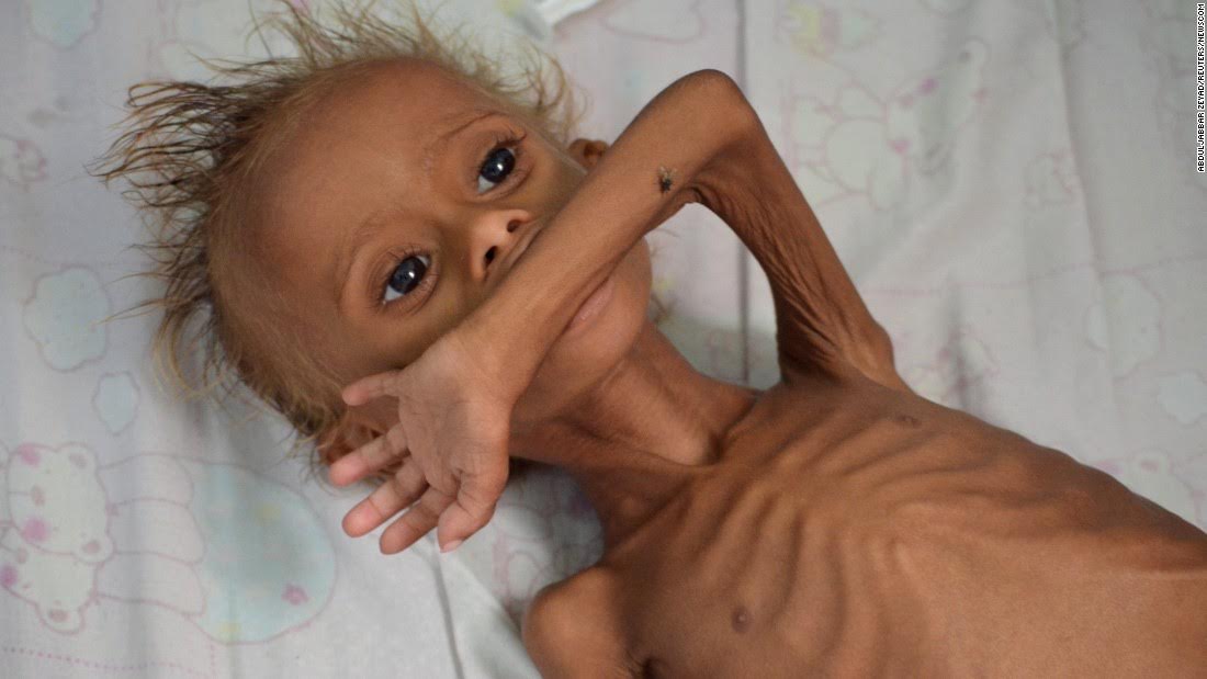В Йемене растет число голодающих