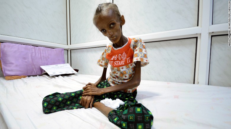 Свыше 5 млн. детей Йемена на грани голода